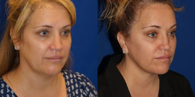 Brow Lift Before and After photo by Texas Facial Aesthetics in Frisco, TX Brow Lift Before and After photo by Texas Facial Aesthetics in Frisco, TX