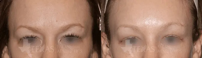 Brow Lift Before and After photo by Texas Facial Aesthetics in Frisco, TX