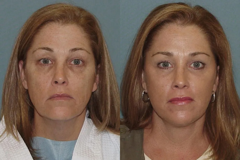 Brow Lift Before and After photo by Texas Facial Aesthetics in Frisco, TX