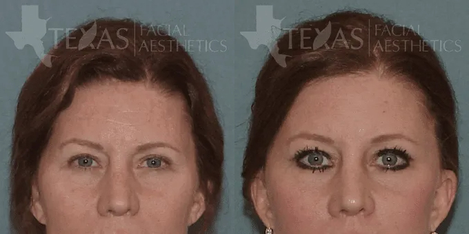 Brow Lift Before and After photo by Texas Facial Aesthetics in Frisco, TX