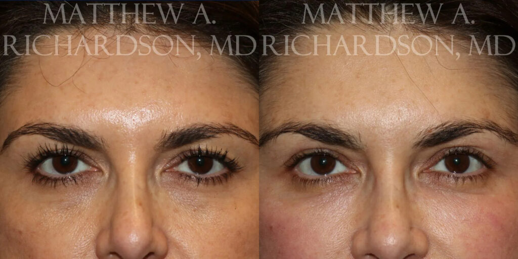 Brow Lift Before and After photo by Texas Facial Aesthetics in Frisco, TX