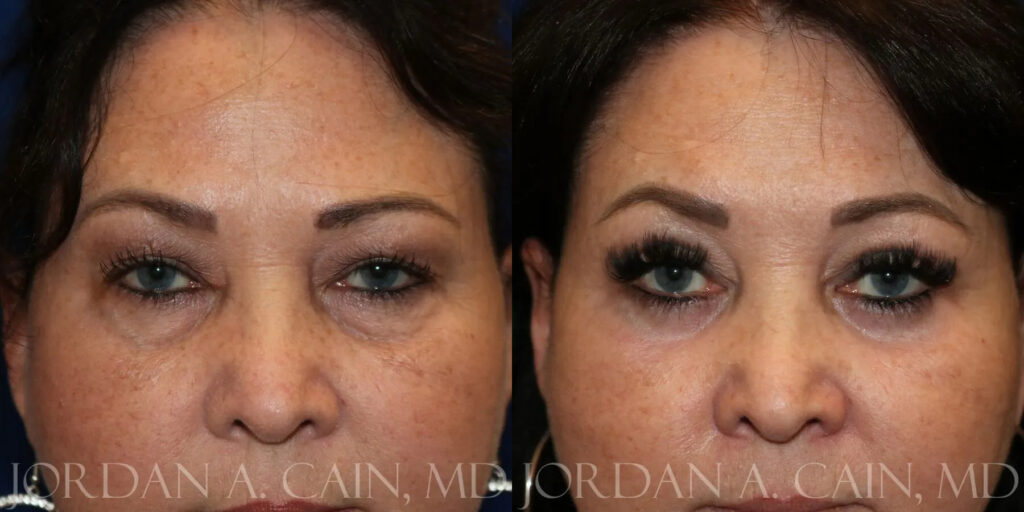 Brow Lift Before and After photo by Texas Facial Aesthetics in Frisco, TX