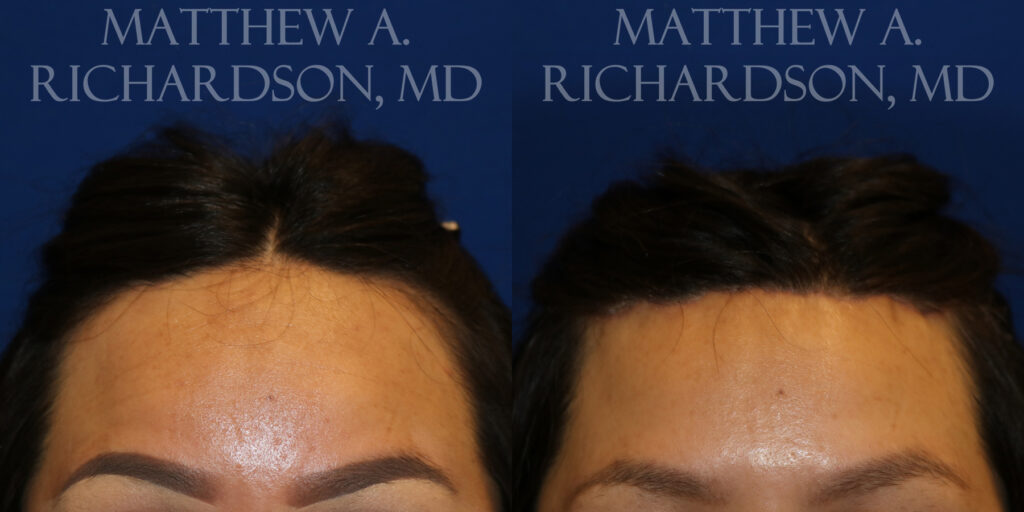 Hairline Lowering (Forehead Reduction) Before and After photo by Texas Facial Aesthetics in Frisco, TX