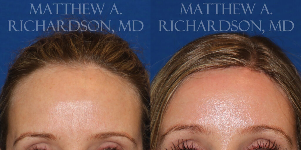 Hairline Lowering (Forehead Reduction) Before and After photo by Texas Facial Aesthetics in Frisco, TX