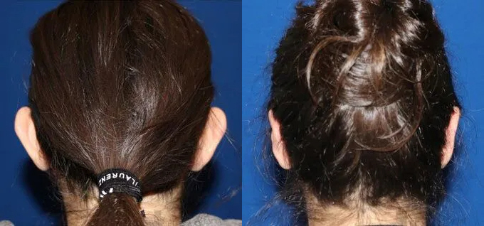Otoplasty (Ears) Before and After photo by Texas Facial Aesthetics in Frisco, TX
