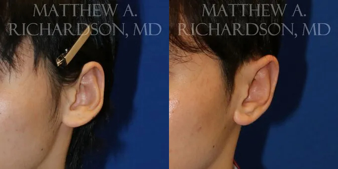 Otoplasty (Ears) Before and After photo by Texas Facial Aesthetics in Frisco, TX