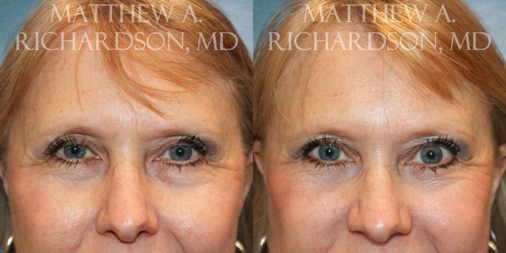 Browlift Before and After photo by Texas Facial Aesthetics in Francisco TX
