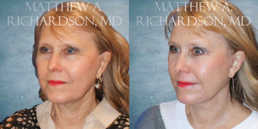 Browlift Before and After photo by Texas Facial Aesthetics in Francisco TX