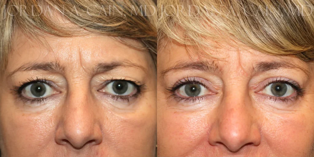 Upper Blepharoplasty Before and After photo by Texas Facial Aesthetics in Francisco TX
