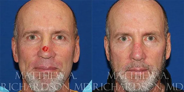 Skin Cancer Reconstruction (Mohs repair) Before and After photo by Texas Facial Aesthetics in Frisco, TX