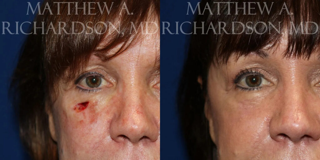 Skin Cancer Reconstruction (Mohs repair) Before and After photo by Texas Facial Aesthetics in Frisco, TX