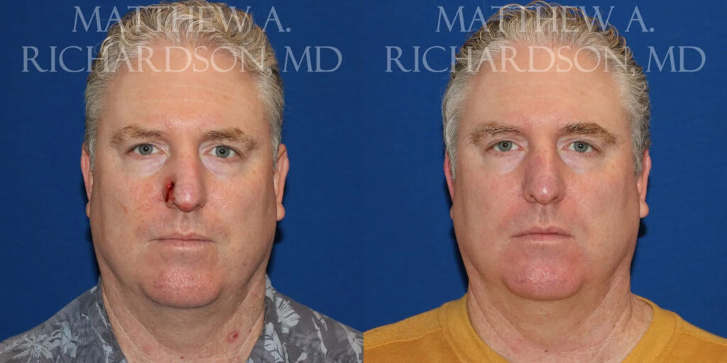 Skin Cancer Reconstruction (Mohs repair) Before and After photo by Texas Facial Aesthetics in Frisco, TX