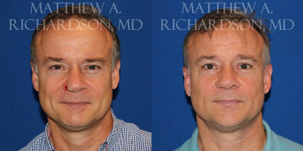 Skin Cancer Reconstruction (Mohs repair) Before and After photo by Texas Facial Aesthetics in Frisco, TX