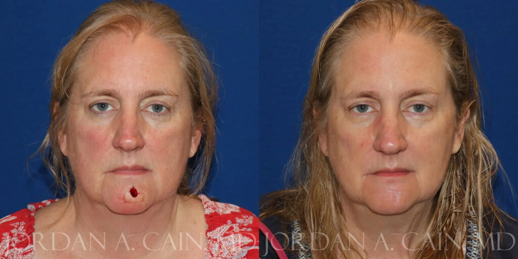 Skin Cancer Reconstruction (Mohs repair) Before and After photo by Texas Facial Aesthetics in Frisco, TX