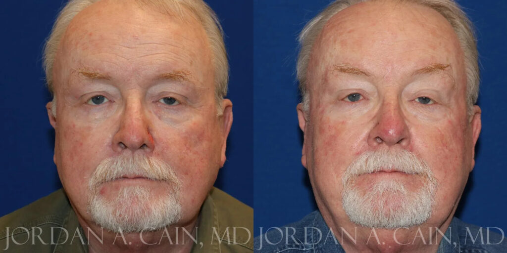 Skin Cancer Reconstruction (Mohs repair) Before and After photo by Texas Facial Aesthetics in Frisco, TX