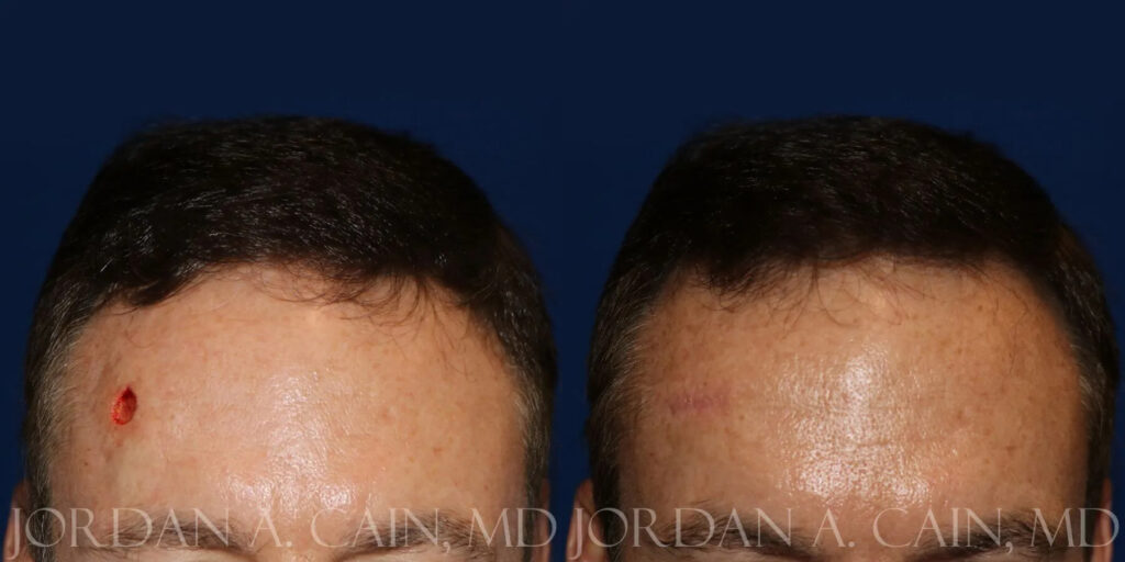 Skin Cancer Reconstruction (Mohs repair) Before and After photo by Texas Facial Aesthetics in Frisco, TX