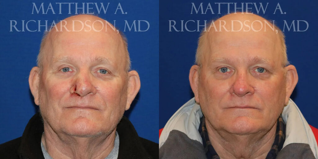 Skin Cancer Reconstruction (Mohs repair) Before and After photo by Texas Facial Aesthetics in Frisco, TX