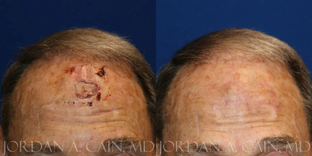 Skin Cancer Reconstruction (Mohs repair) Before and After photo by Texas Facial Aesthetics in Frisco, TX