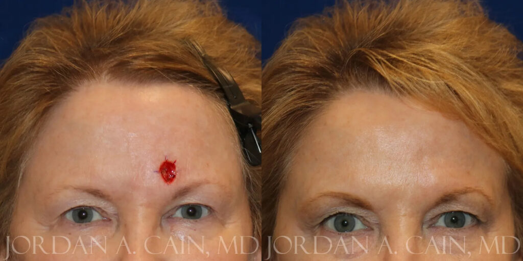 Skin Cancer Reconstruction (Mohs repair) Before and After photo by Texas Facial Aesthetics in Frisco, TX