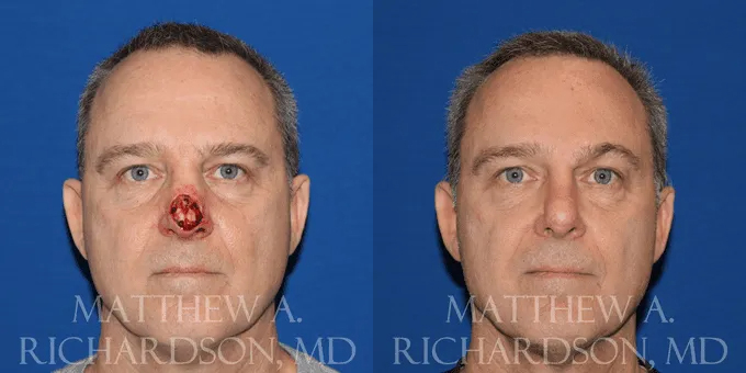 Skin Cancer Reconstruction (Mohs repair) Before and After photo by Texas Facial Aesthetics in Frisco, TX