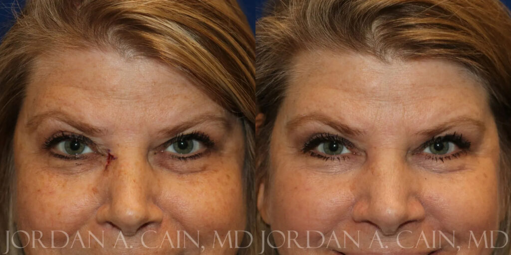 Skin Cancer Reconstruction (Mohs repair) Before and After photo by Texas Facial Aesthetics in Frisco, TX