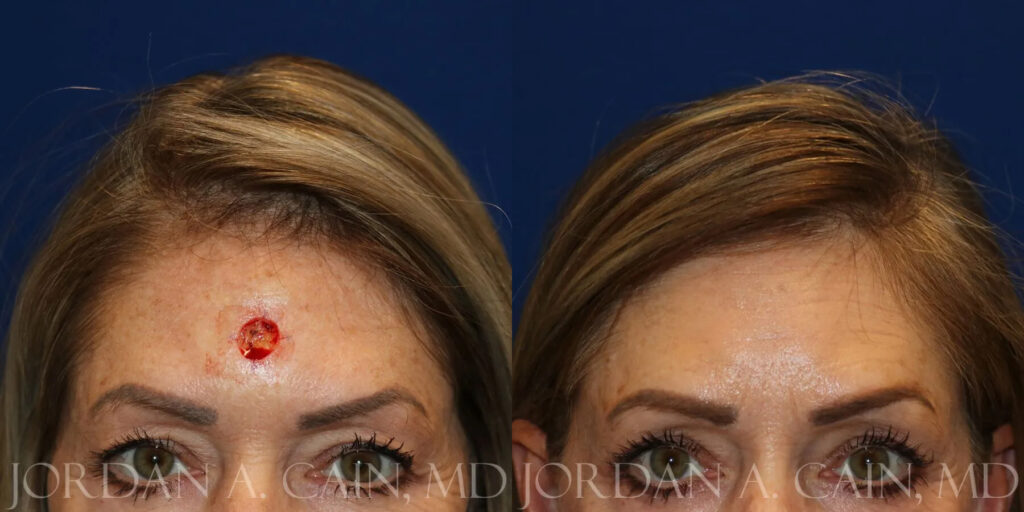 Skin Cancer Reconstruction (Mohs repair) Before and After photo by Texas Facial Aesthetics in Frisco, TX