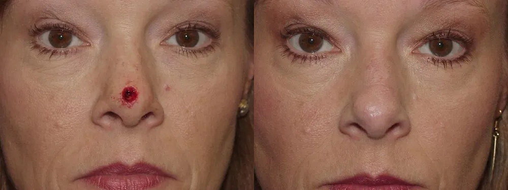 Skin Cancer Reconstruction (Mohs repair) Before and After photo by Texas Facial Aesthetics in Frisco, TX