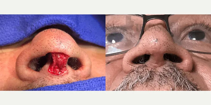 Skin Cancer Reconstruction (Mohs repair) Before and After photo by Texas Facial Aesthetics in Frisco, TX