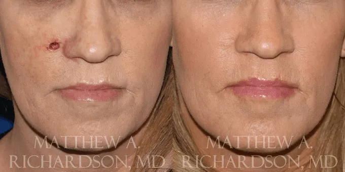 Skin Cancer Reconstruction (Mohs repair) Before and After photo by Texas Facial Aesthetics in Frisco, TX