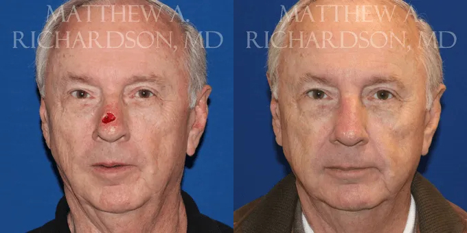 Skin Cancer Reconstruction (Mohs repair) Before and After photo by Texas Facial Aesthetics in Frisco, TX