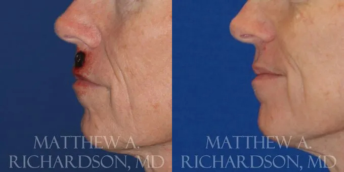 Skin Cancer Reconstruction (Mohs repair) Before and After photo by Texas Facial Aesthetics in Frisco, TX