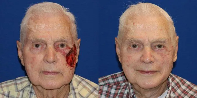 Skin Cancer Reconstruction (Mohs repair) Before and After photo by Texas Facial Aesthetics in Frisco, TX