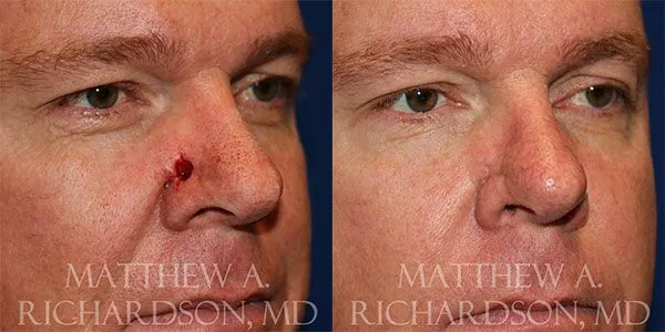 Skin Cancer Reconstruction (Mohs repair) Before and After photo by Texas Facial Aesthetics in Frisco, TX