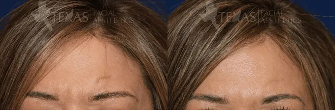 Scar Revision Before and After photo by Texas Facial Aesthetics in Frisco, TX