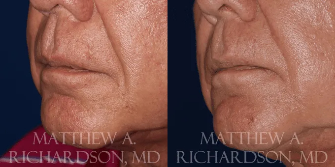 Scar Revision Before and After photo by Texas Facial Aesthetics in Frisco, TX