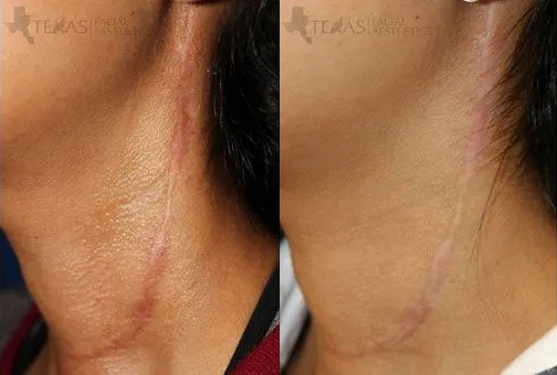 Scar Revision Before and After photo by Texas Facial Aesthetics in Frisco, TX