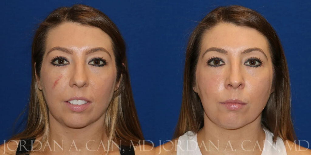 Scar Revision Before and After photo by Texas Facial Aesthetics in Frisco, TX