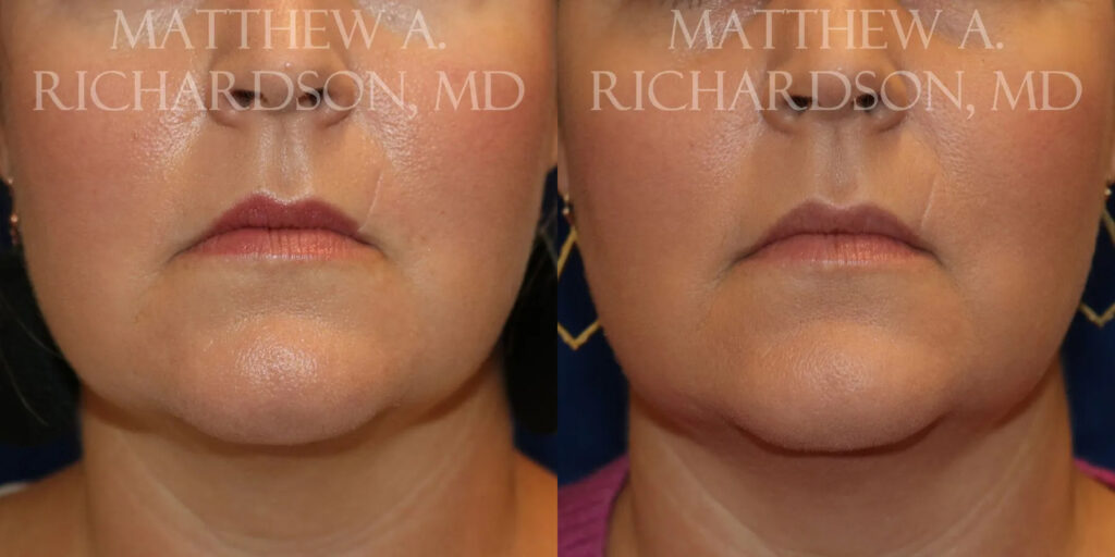 Scar Revision Before and After photo by Texas Facial Aesthetics in Frisco, TX