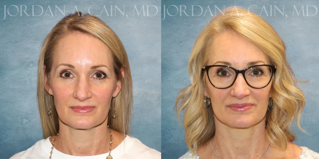 Neck Lift Before and After photo by Texas Facial Aesthetics in Francisco TX