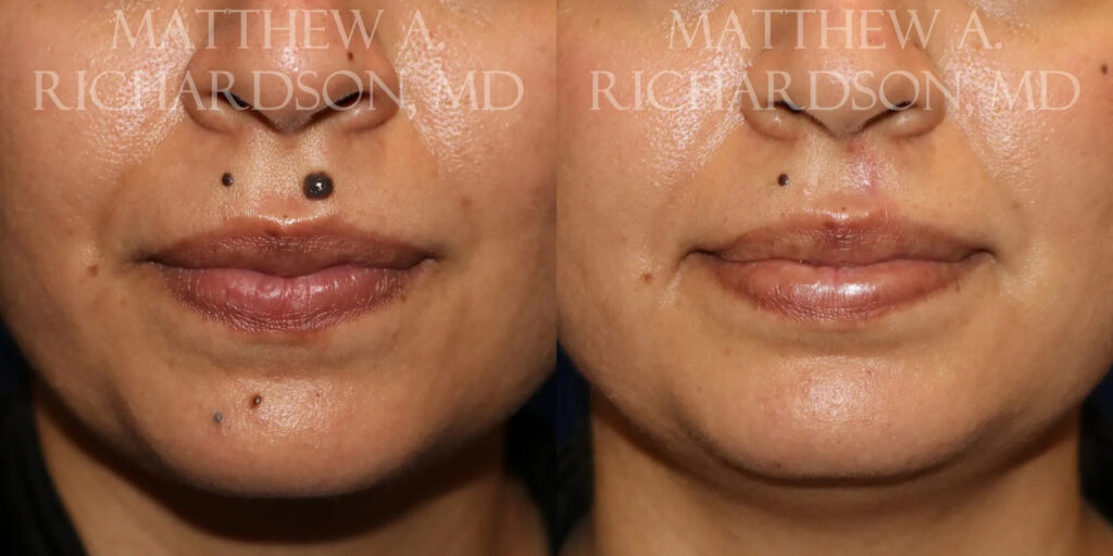 Mole Removal Before and After photo by Texas Facial Aesthetics in Frisco, TX