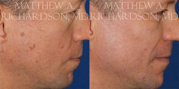 Mole Removal Before and After photo by Texas Facial Aesthetics in Frisco, TX