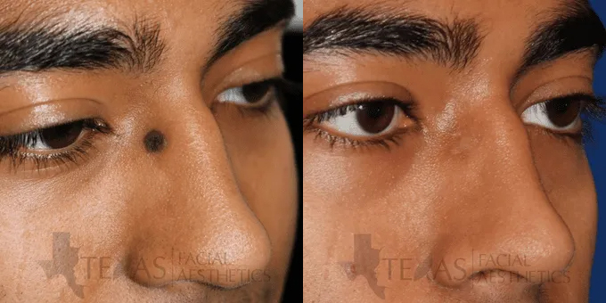 Mole Removal Before and After photo by Texas Facial Aesthetics in Frisco, TX