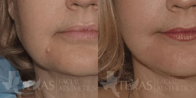 Mole Removal Before and After photo by Texas Facial Aesthetics in Frisco, TX