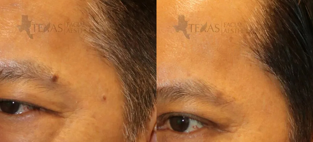 Mole Removal Before and After photo by Texas Facial Aesthetics in Frisco, TX