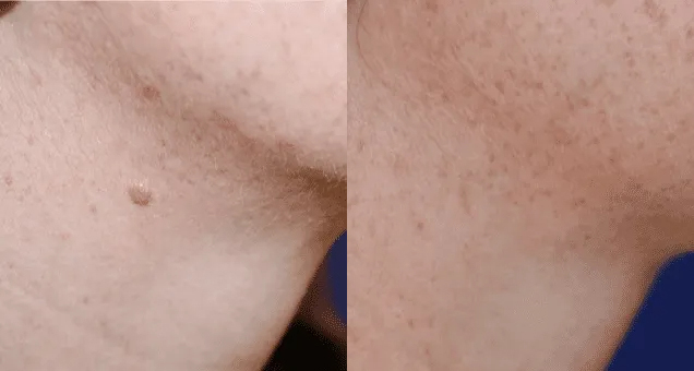 Mole Removal Before and After photo by Texas Facial Aesthetics in Frisco, TX