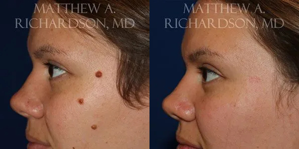 Mole Removal Before and After photo by Texas Facial Aesthetics in Frisco, TX