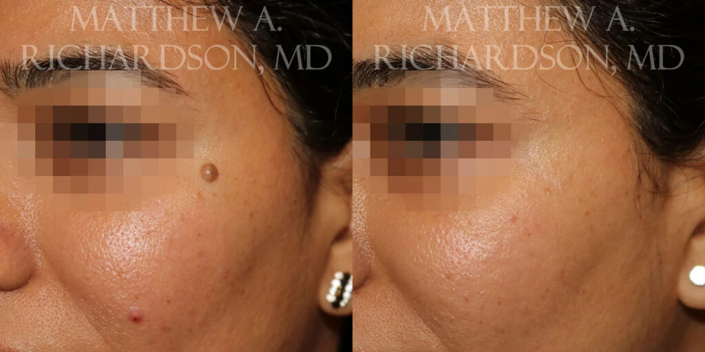 Mole Removal Before and After photo by Texas Facial Aesthetics in Frisco, TX