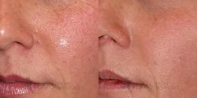 Mole Removal Before and After photo by Texas Facial Aesthetics in Frisco, TX