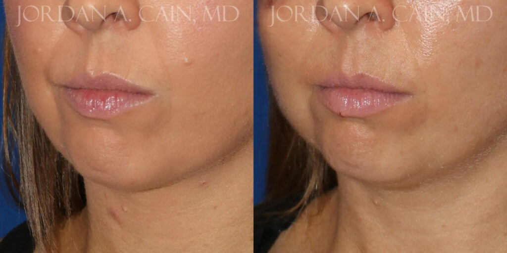 Mole Removal Before and After photo by Texas Facial Aesthetics in Frisco, TX