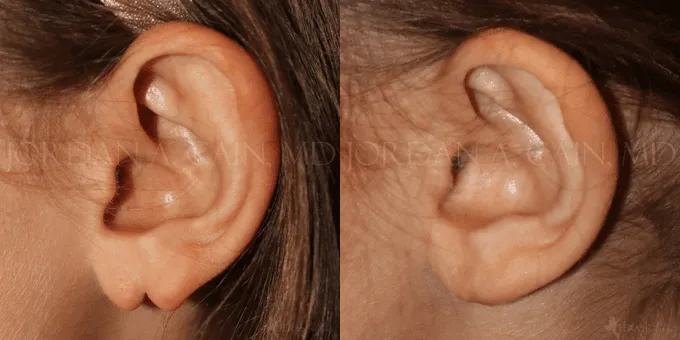 Earlobe Repair Before and After photo by Texas Facial Aesthetics in Frisco, TX